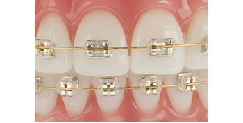 iconix aesthetic braces