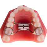 palatal expander